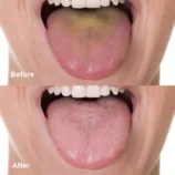 LIMETOW™-Tongue-Cleaner8