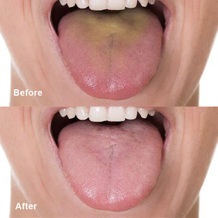 LIMETOW™-Tongue-Cleaner8 LIMETOW™-Tongue-Cleaner8