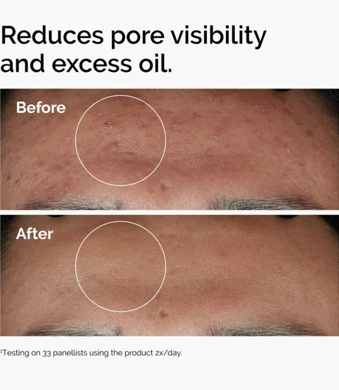 ord-niacinamide-zinc-blemish-serum-before-after-pores