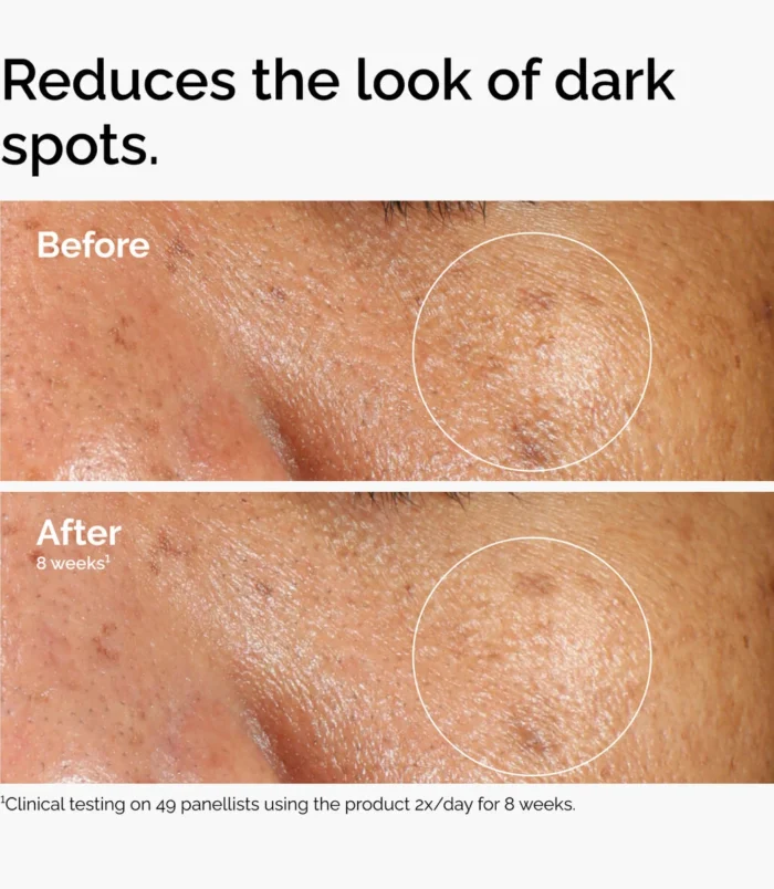 ord-alpha-arbutin-before-after-dark-spots